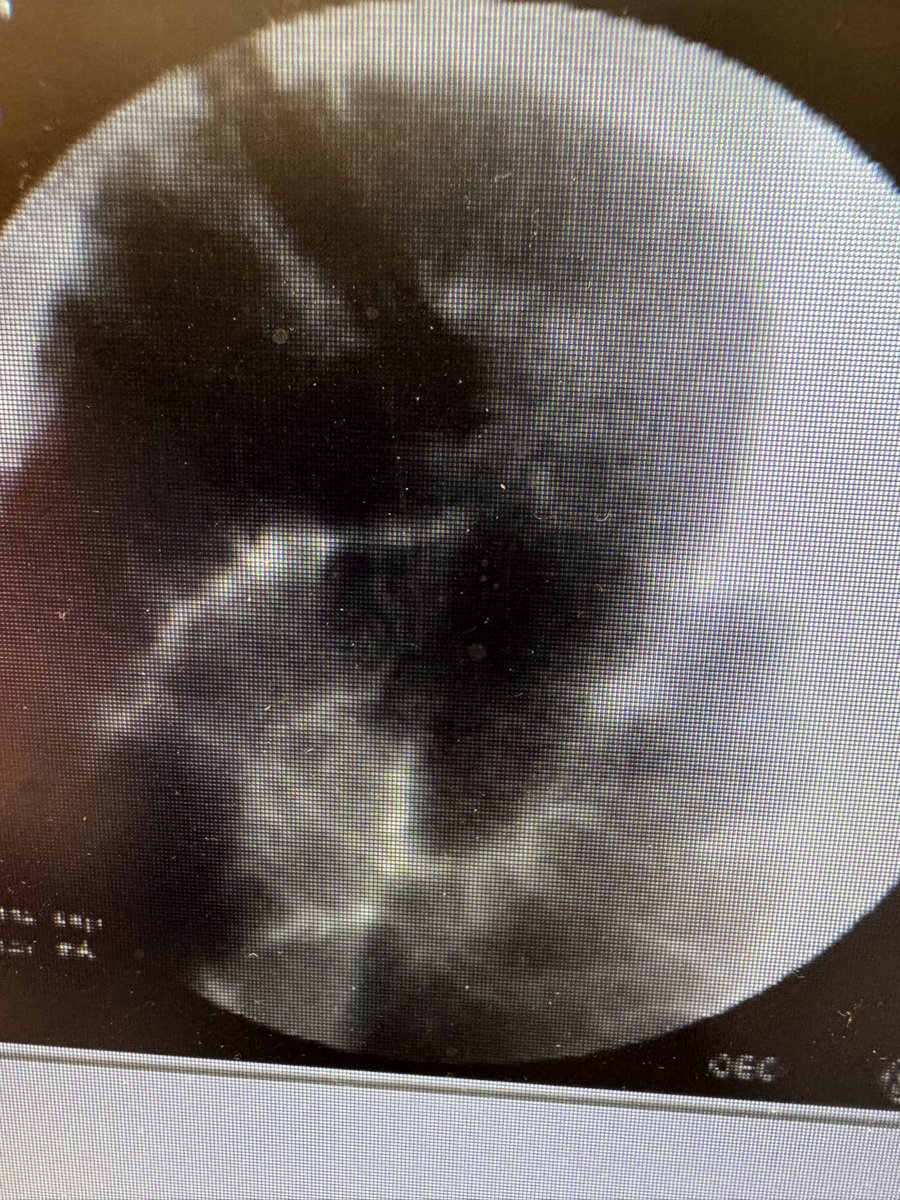 Sanmeet Singh MD (@sanmeetsingh07) on Twitter photo Another successful EUS-guided gastrojejunostomy today! Transforming care for malignant gastric outlet obstructionโminimally invasive, effective, and life-changing for our patient. Grateful for the team and the power of advanced endoscopy! #EUS <a href="/ASGEendoscopy/">ASGE GI Endoscopy</a> #GItwitter Another successful EUS-guided gastrojejunostomy today! Transforming care for malignant gastric outlet obstructionโminimally invasive, effective, and life-changing for our patient. Grateful for the team and the power of advanced endoscopy! #EUS <a href="/ASGEendoscopy/">ASGE GI Endoscopy</a> #GItwitter