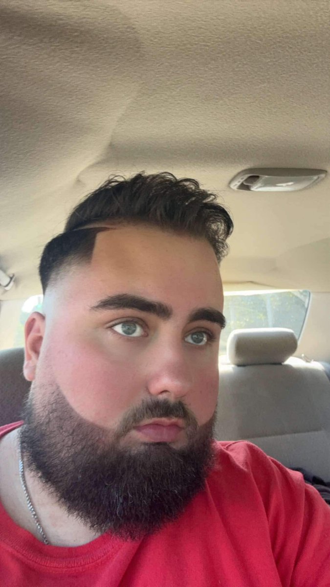 DenaroJorts's tweet photo. ~340 months after no hair transplant. 👍

- Denaro https://t.co/zYKVPNuSWh