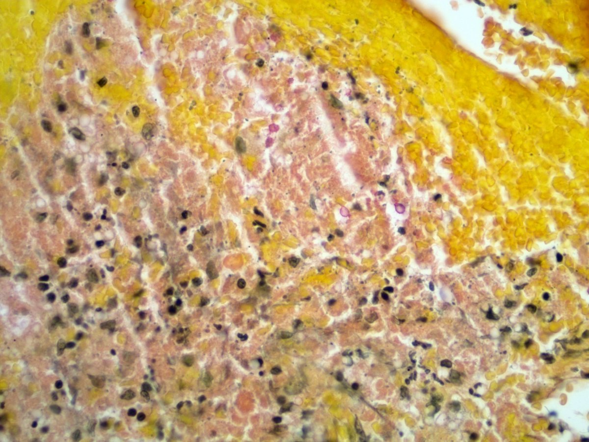 smlungpathguy's tweet image. 207/
On mucicarmine, Cryptococcus stains red due to binding of aluminum-carmine complexes to acid mucin. But let&apos;s take a minute to acknowledge the yellow background, which is due to the dye/counterstain Tartrazine
@yro854 @MirunaPopescu13 @ariella8 #tweetcyclopedia #pathbugs…