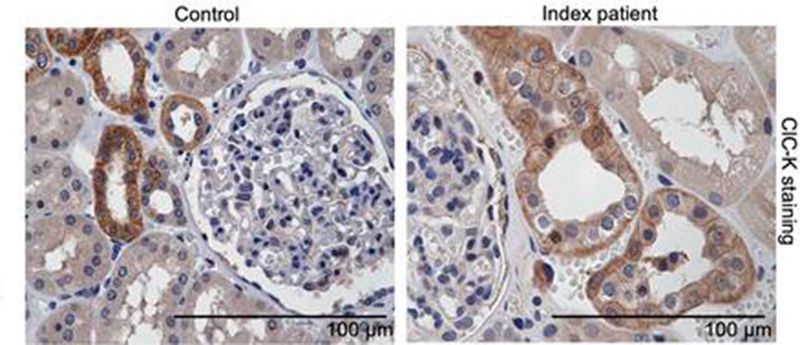 ASCI (@the_asci) on Twitter photo Patient mutation provides new insight into chloride channel ClC-Kb: insight.jci.org/articles/view/…
The study from ASCI member Vivek Bhalla and team shows implications for electrolyte handling in kidney disease. <a href="/BhallaResearch/">Laboratory of Vivek Bhalla, MD- Stanford</a> <a href="/StanfordNeph/">Stanford Nephrology</a> <a href="/StanfordMCHRI/">Stanford Maternal & Child Health Research Inst.</a> <a href="/StanfordDeptMed/">Stanford Department of Medicine</a>
Despite Patient mutation provides new insight into chloride channel ClC-Kb: insight.jci.org/articles/view/…
The study from ASCI member Vivek Bhalla and team shows implications for electrolyte handling in kidney disease. <a href="/BhallaResearch/">Laboratory of Vivek Bhalla, MD- Stanford</a> <a href="/StanfordNeph/">Stanford Nephrology</a> <a href="/StanfordMCHRI/">Stanford Maternal & Child Health Research Inst.</a> <a href="/StanfordDeptMed/">Stanford Department of Medicine</a>
Despite