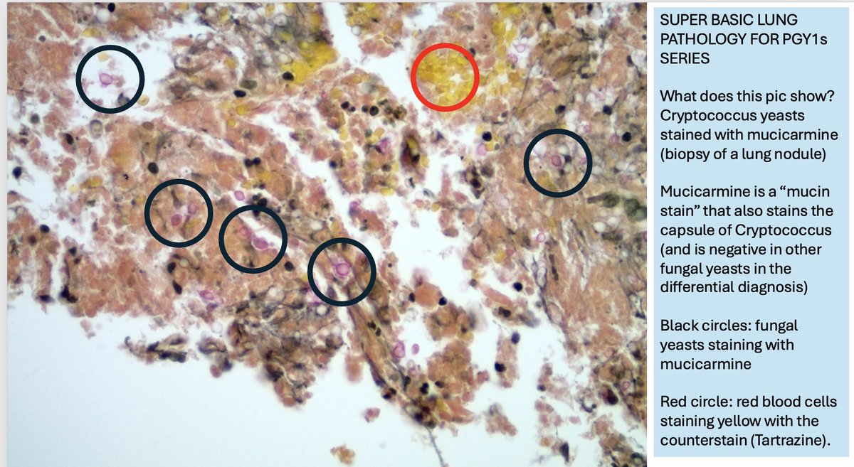 smlungpathguy's tweet image. 41. PGY1s: you will see mucicarmine being used as a &quot;mucin stain&quot; in adenocarcinomas, but it also has a cool use in the diagnosis of a fungus called Cryptococcus
#pathbugs #crittersontwitter