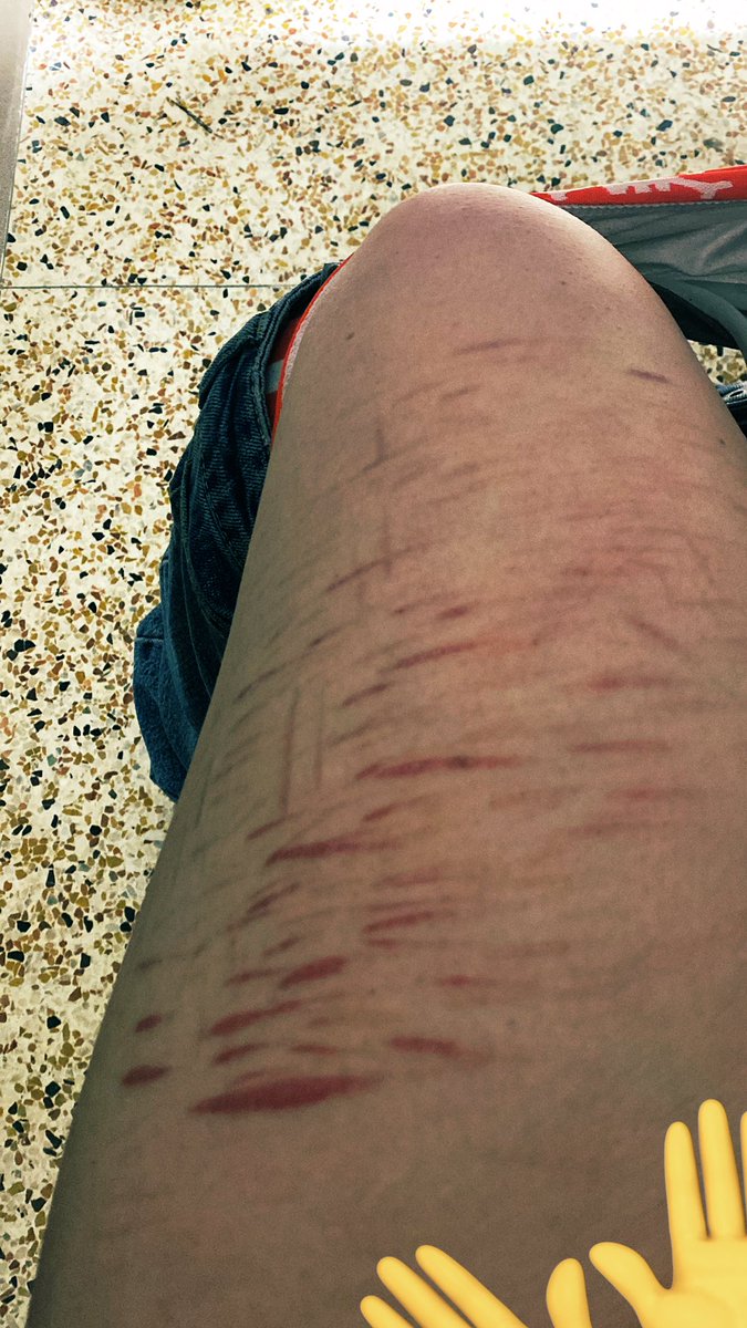 biteholte's tweet image. kinda obsessed w my scars kinda want more…