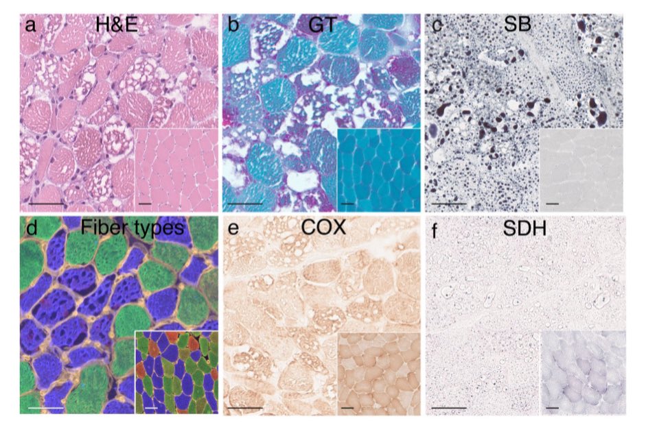 Another series of 11 patients with #lipid storage #myopathy (MADD-like) &amp; #Sertraline exposure from #Sweden (again). Elegant #neuropathology study shows an underlying acquired #mitochondria defect. 
🧐 Who are at risk of developing this?