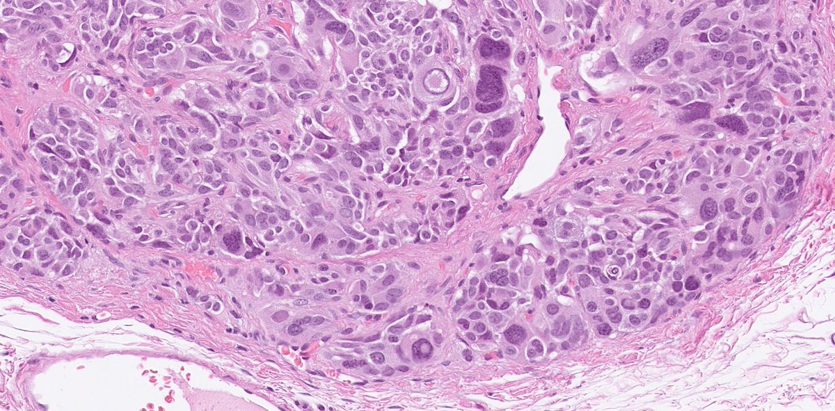 DrJuhlin's tweet photo. Medullary thyroid carcinoma (MTC) can show pleomorphic nuclei with bizarre shapes and inclusions. This low-grade MTC (Ki-67 <1%) demonstrates striking yet misleading features that might resemble anaplastic or papillary thyroid carcinoma. Morphology can be deceptive! https://t.co/Lw7itctOTd