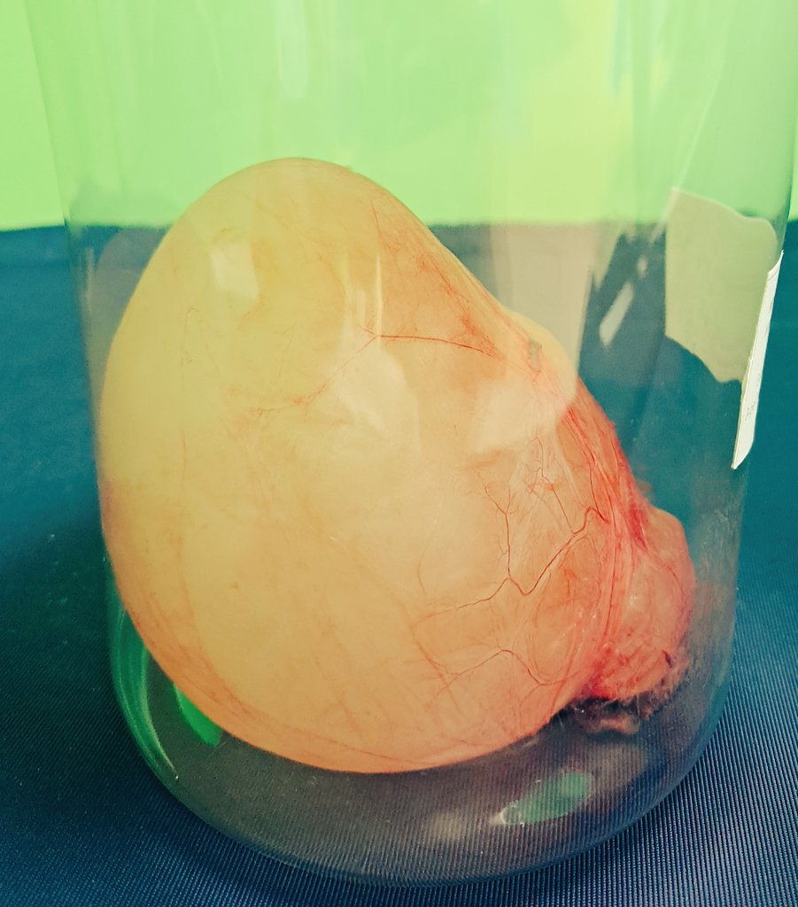 قيلة مائية متكيسة تم إزالتها كاملة بتوفيق من الله ..
Intact encysted hydrocele.