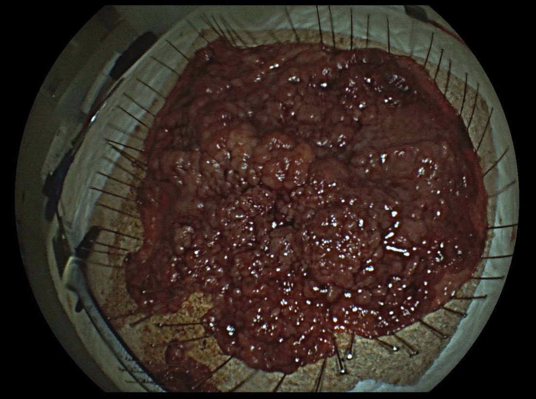 mifraile (@mfraile90) on Twitter photo Large circumferential rectal ESD (200x160mm, HGD, 371 min). Keep on going with organ preserving procedures! #GITwitter #MedEd #Endoscopy #Endoscopia <a href="/endoscopyjrnl/">Endoscopy Journal</a>
<a href="/DigValdecilla/">DigestivoValdecilla</a> <a href="/ESGE_news/">ESGE</a> <a href="/HUnivValdecilla/">Hospital Universitario Marqués de Valdecilla</a> <a href="/SEEDendoscopia/">SEED</a> <a href="/sepdigestiva/">Sociedad Española de Patología Digestiva (SEPD)</a> Large circumferential rectal ESD (200x160mm, HGD, 371 min). Keep on going with organ preserving procedures! #GITwitter #MedEd #Endoscopy #Endoscopia <a href="/endoscopyjrnl/">Endoscopy Journal</a>
<a href="/DigValdecilla/">DigestivoValdecilla</a> <a href="/ESGE_news/">ESGE</a> <a href="/HUnivValdecilla/">Hospital Universitario Marqués de Valdecilla</a> <a href="/SEEDendoscopia/">SEED</a> <a href="/sepdigestiva/">Sociedad Española de Patología Digestiva (SEPD)</a>