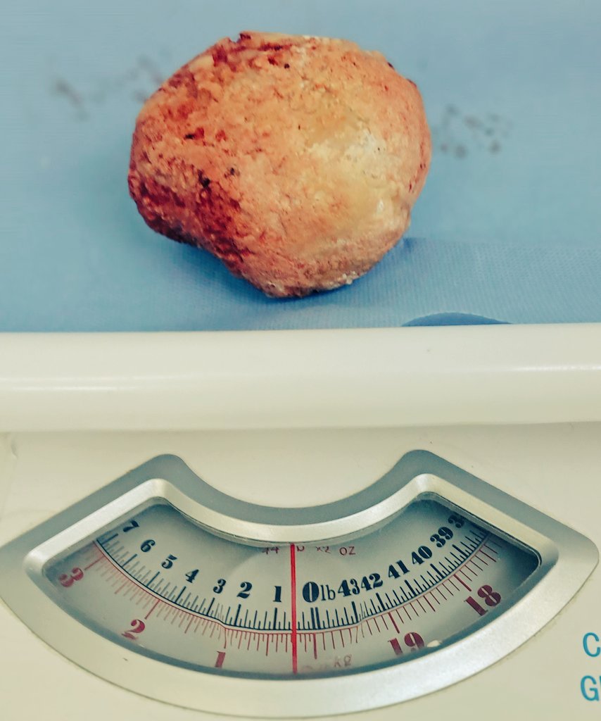 بفضل الله.. تم استخراج حصوة ٢٠٠ جم بالكامل من مريض و إنهاء معاناته لسنوات. 
200 gm stone bladder. 
<a href="/stones/">stones</a>
د. محمد بكر محمد 
مسالك بوليه