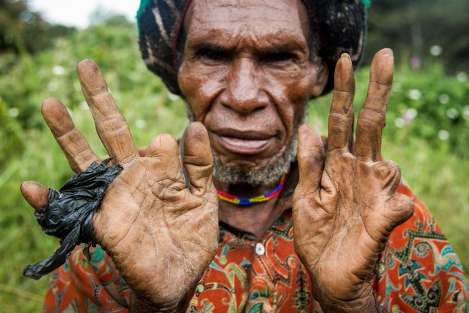 _kingjonah's tweet image. The most unique traditions around the world 

1. In Papua New Guinea, when someone dies, family members cut off their own fingers as a sign of mourning.