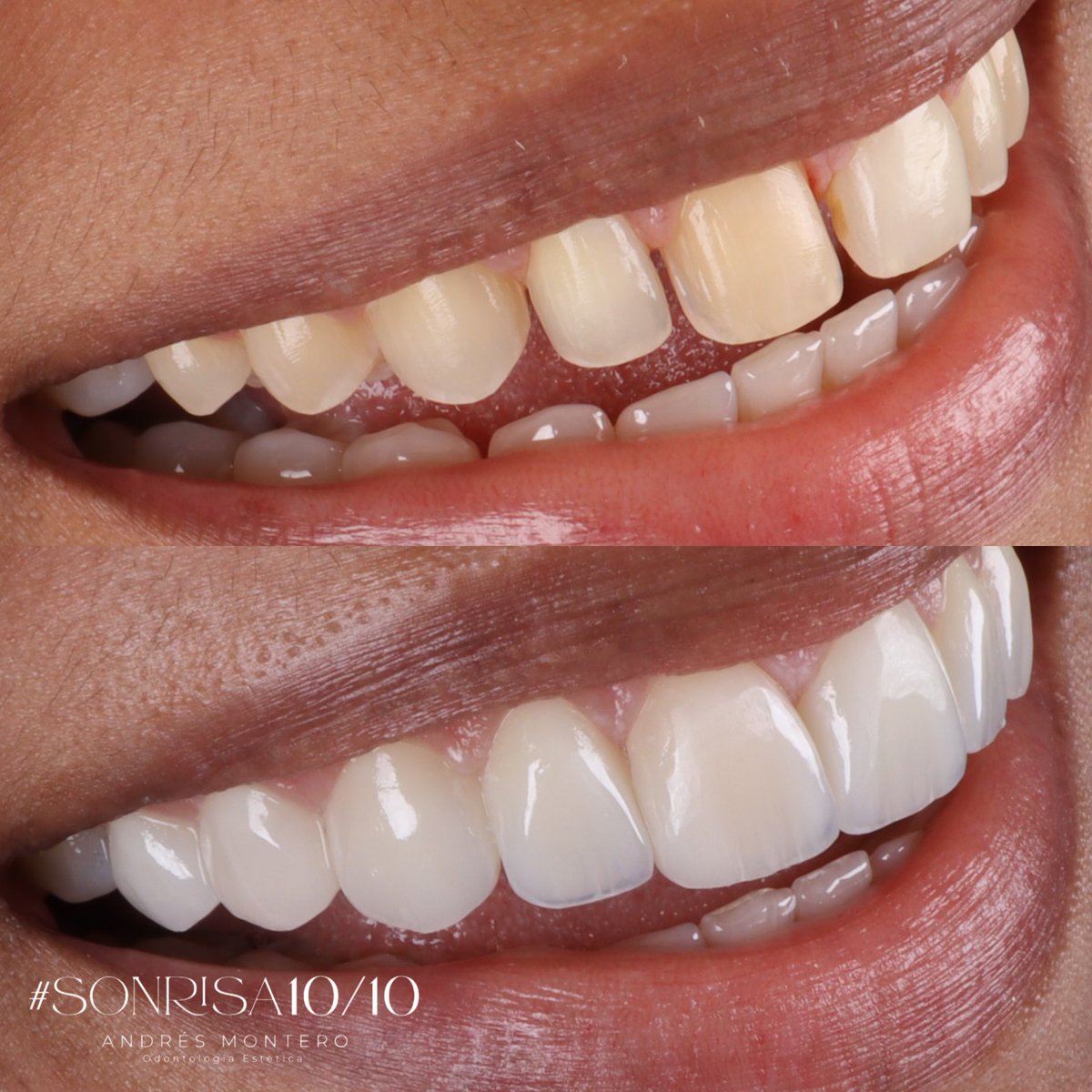 andresmontero03's tweet photo. Disilicato de litio https://t.co/JDXEuXFxGB