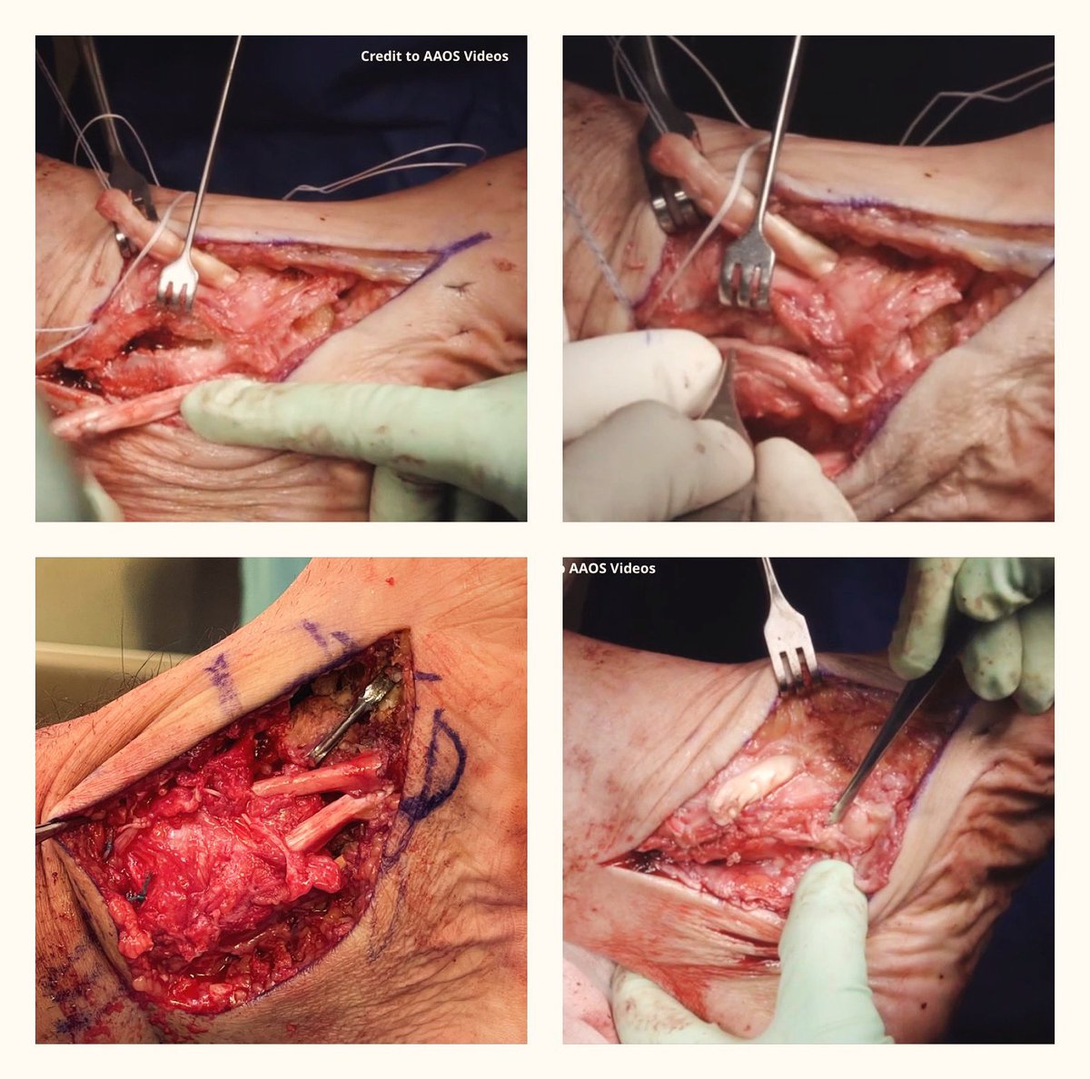 PTTD with Deltoid insufficiency. Clinical photos showing the utilization of the intact posterior tibial tendon insertion, cutting its proximal end, and transferring it to the medial malleolus to function as a static stabilizer, enhancing deltoid repair and medial stability.