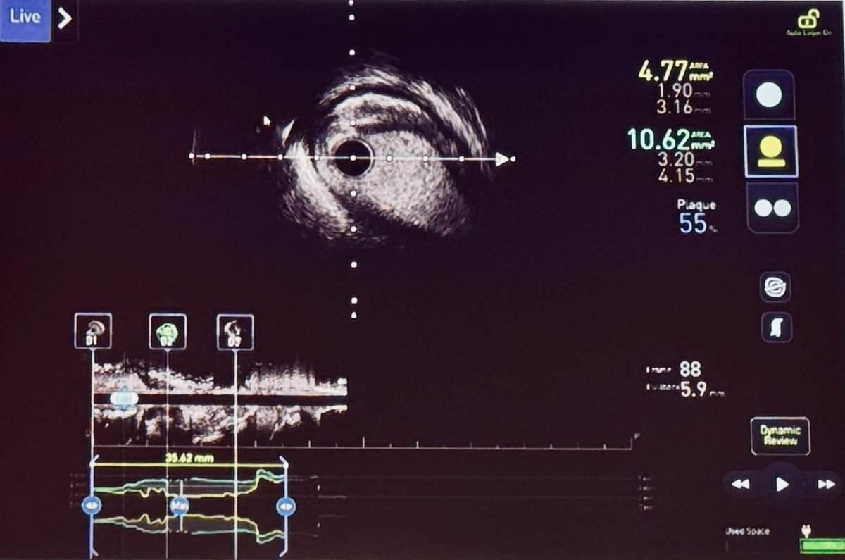 ACTOS_VUmc's tweet photo. AWE…? Gaia Next 2nd to puncture the cap then wire “selection” / de-escalation to then access a large Diagonal also seen on the IVUS https://t.co/HLyWnXRI4w
