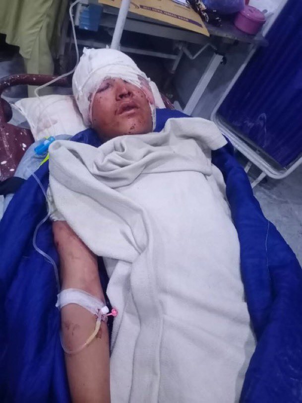 afnan_wazir19's tweet photo. دشمالي وزيرستان په برمل تحصيل راغزئي سيمه کې ديو ماين په چاؤدنه کې دښوونځي دوه ماشومان سخت ژوبل شوي دي.
ژوبل کسانو کښې امداد الله او منير د وانا ډي ايچ کيو هسپتال نه ډي آئي خان هيډکوارټر هسپتال ته منتقل کړے شوي دي
#DeMineExFata
@PtmPeshawar @PTMEurope @PTMupdate @PashtunNJirga https://t.co/T4dlhx2aKU
