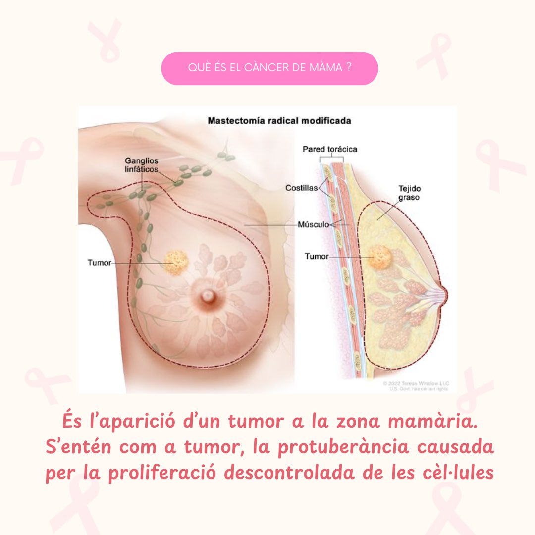 DescobertesUB's tweet photo. Deixem aquí una petita guia de què és el càncer de mama i com el podem detectar!  #breast #breastcancer #breastcancerawareness #cancer #ub #cancerdemama #mama #Barcelona https://t.co/grL5XqxLwB