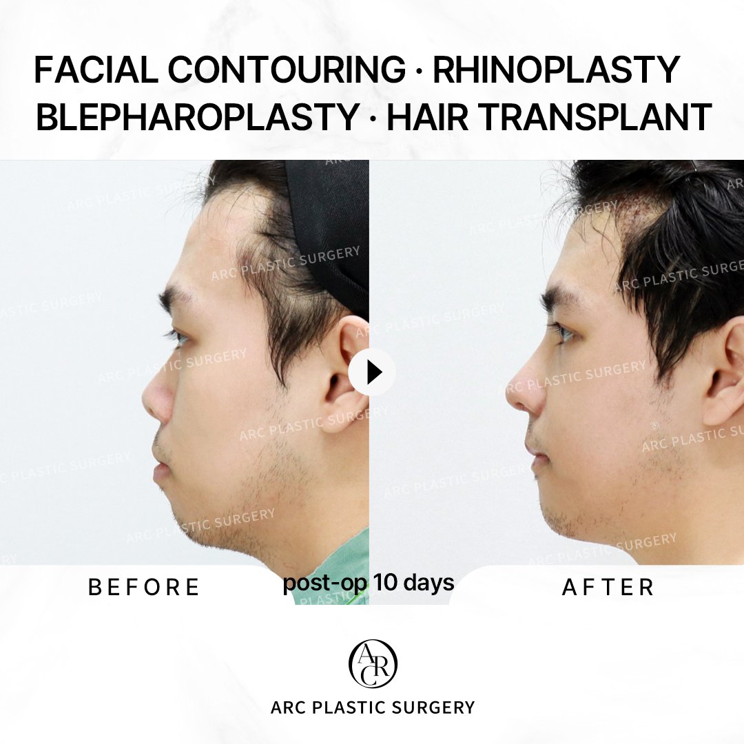 dr_kwonsoonbeom's tweet photo. [FINE ARC]
Facial contouring &amp; Hair transplant
✔by Dr. Kwon Soon Beom
Blepharoplasty &amp; Rhinoplasty
✔by Dr. Kim Seo Young
**
3 points of Facial contouring
Hair transplant
Blepharoplasty
-incisional ptosis correction
-epi-canthoplasty
Rhinoplasty
#arcplasticsurgery #makeover https://t.co/2XB7VmxNja