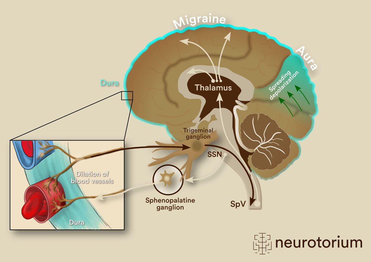 Did you know that migraine attacks are triggerable?

Learn more in the latest Neurotorium article on the Human Models of Migraine and Scientific Advances in Migraine Treatments by Rune Häckert Christensen: neurotorium.org/human-models-o…

#Migraine #Neurology