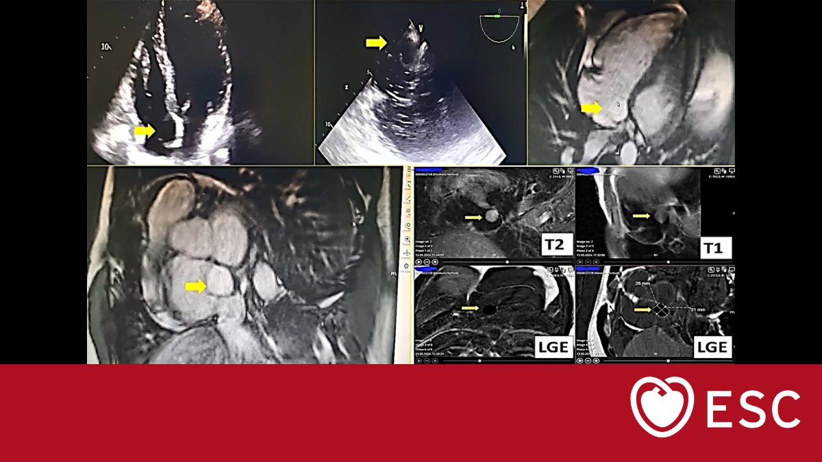 escardio's tweet photo. #ImageOfTheWeek by Redouane Bouras from the Klinikum Herford, Germany.
A man in his 30s presents with lung artery embolism. What is the most possible diagnosis of the incidence finding? https://t.co/QXy4EmXMwA
#cardioed #ESCYoung https://t.co/ZnFEgMUI3w