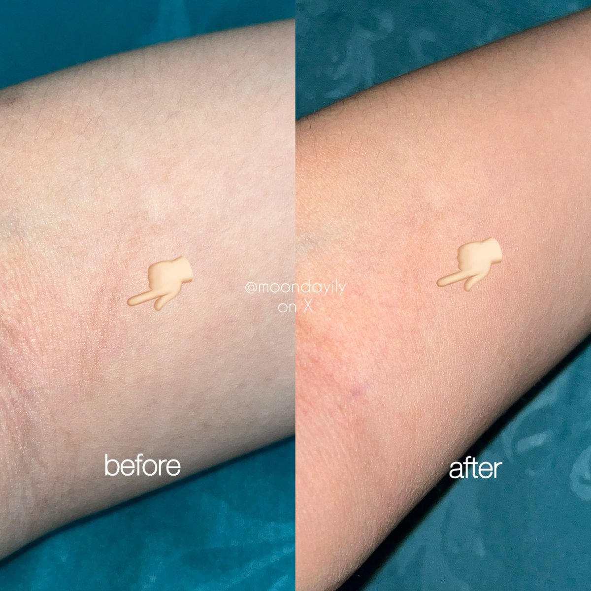 moondayily's tweet photo. punya bekas luka akibat goresan kawat terus jadi memudar banget berkat Body Serum All Perfcet karena ada kandungan Niacinamide 7% yang ampuh buat mencerahkan🥰 ditambah kulit aku jadi lebih lembab, gak kering kerontang lagii 😍 https://t.co/wiwmDs18Qk