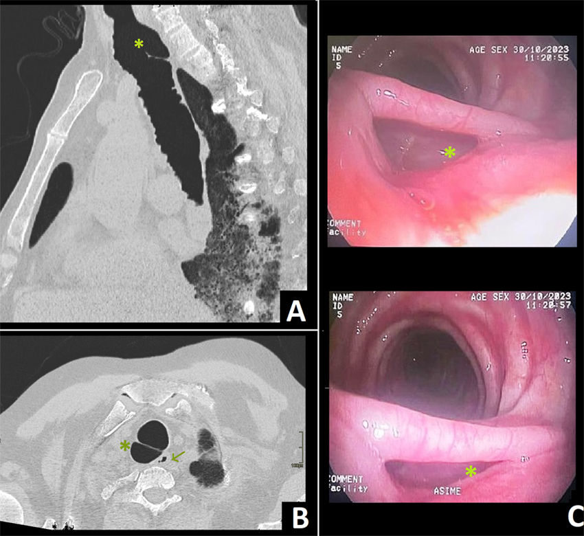 👉 Divertículo traqueal gigante en paciente con esclerosis sistémica.

📸 Un caso excepcional en #OpenRespiratoryArchives 

🔗 Accede aquí: n9.cl/qkj5d

#SEPAR