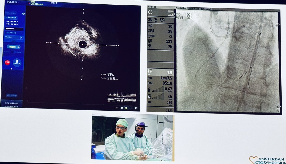 Live Case 3: Drs Maksymilian Opolski 🇵🇱 and Sina Porouchani 🇫🇷 make seift antegrade work of a RCA CTO with “hands on” viewing of wiring techniques <a href="/OpolskiMP/">Maksymilian Opolski</a> #actos2024 #actos