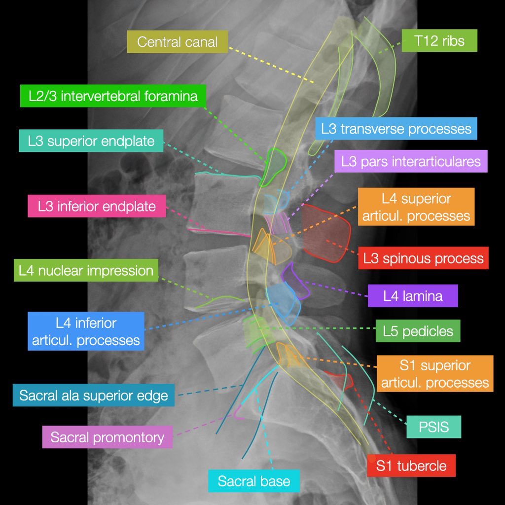 Interesting X-RAY interpretation points for lumbar X-ray!