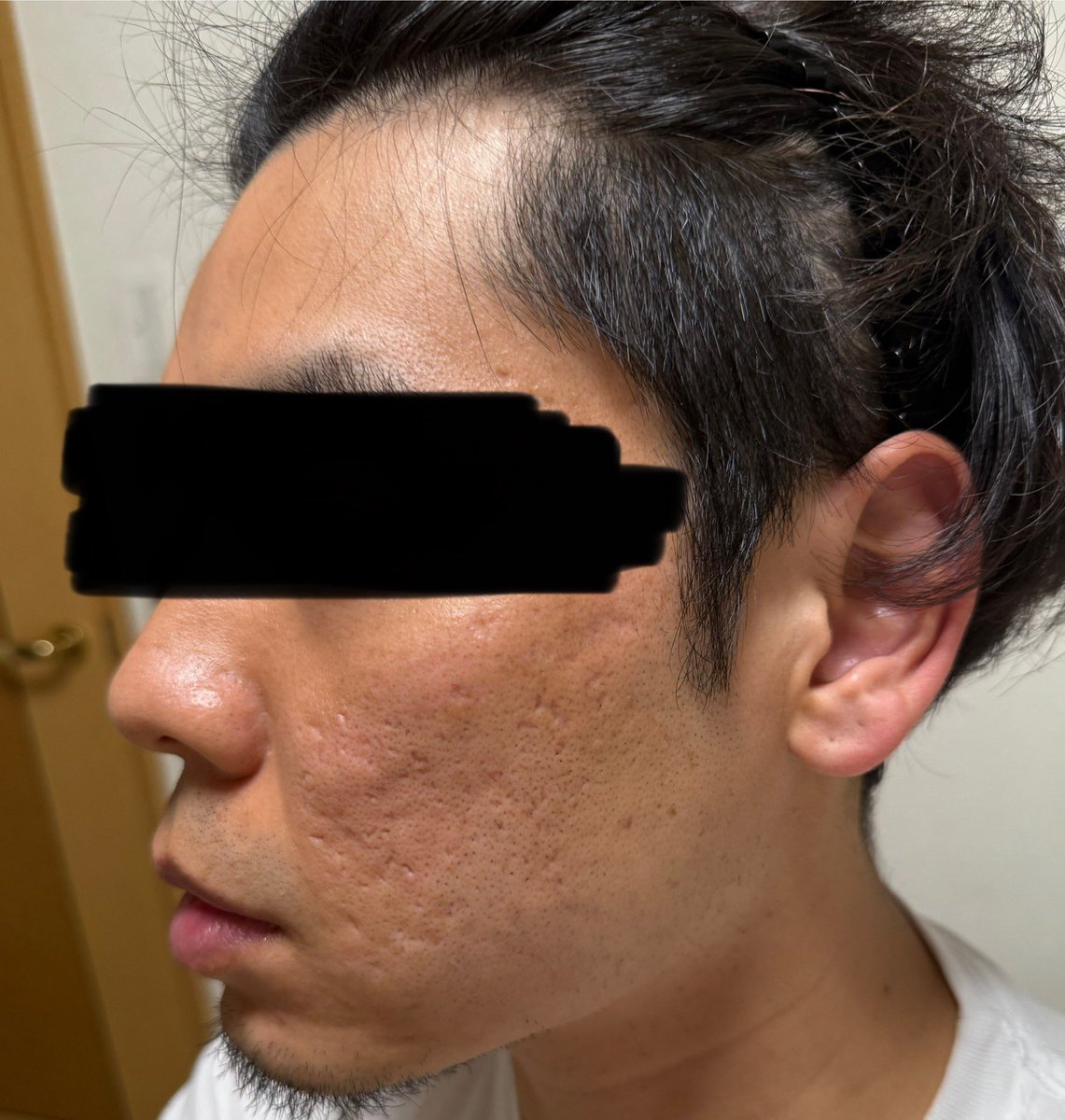 nikibman's tweet photo. グランメドで施術を受けて80日くらい経ちました！2回目同じ施術を受けるかTCAクロスにするか悩んでいます。

クレーター治療時間も金もかかるし正直うぜぇー！！というのが正直な所です笑

まだ諦めず続けます😇 https://t.co/WV4Bo37Tbd