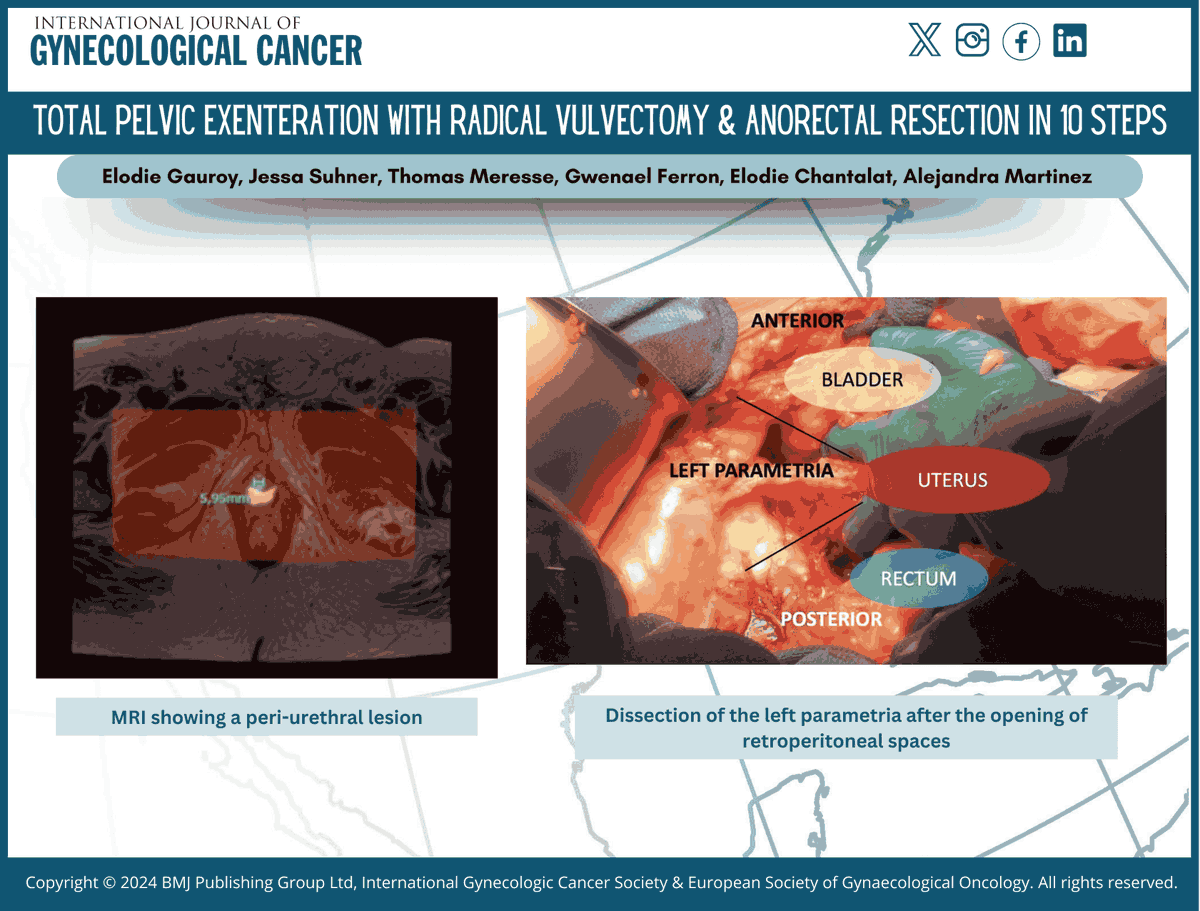 IJGConline's tweet photo. #VideoArticle
Check out our video on total pelvic #exenteration with #radical #vulvectomy & #anorectal resection in #10steps by @EGauroy @amtzcannon
📹 https://t.co/VAuQga0nl9
@pedroramirezMD @HsuMd @JayrajAarthi @AndreFernandes2 @IGCSociety @ESGO_society @ENYGO_official @OncoAlert @IJGCfellows @GynMe4 @RParejaGineOnco @lchiv4 @annafagottimd @HousseinELHAJJ3 @AinhoaMada @Jc_vilches @erodriguezglez @daggezmine @astraubhar
#IJGConline #Research #Prevention #Treatment #Diagnostic #GynCancer #GynOnc #WomenHealth #SoMe #SoMe4GynOnc
