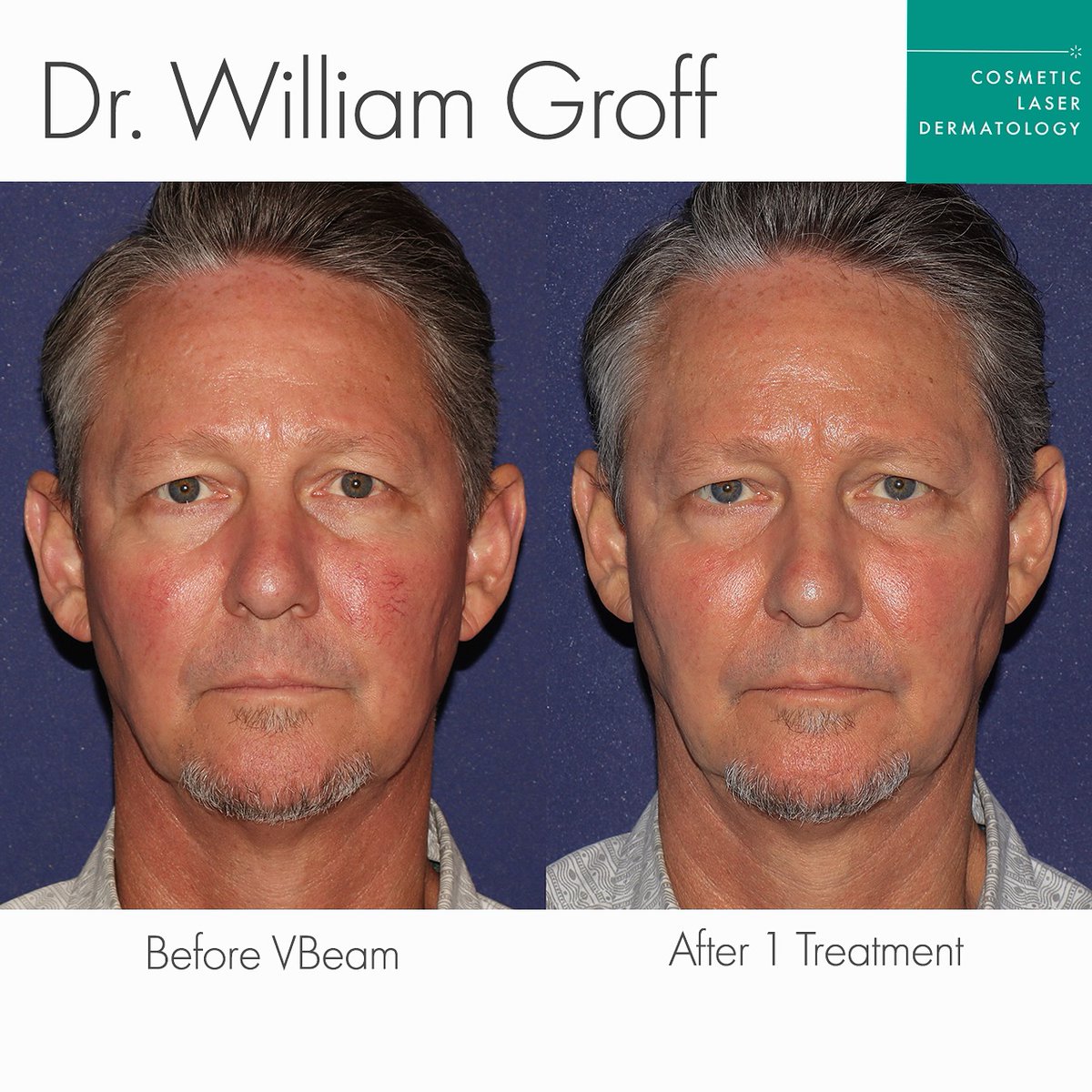 CandelaMedical1's tweet photo. A beautiful transformation by Dr. William Groff , expertly addressing his patient’s redness and broken capillaries after just a single session using the Vbeam Laser.
#Vbeam effectively targets vascular concerns with precision and care, restoring clear, even-toned skin.
REPOST https://t.co/xRgYNiSxXE