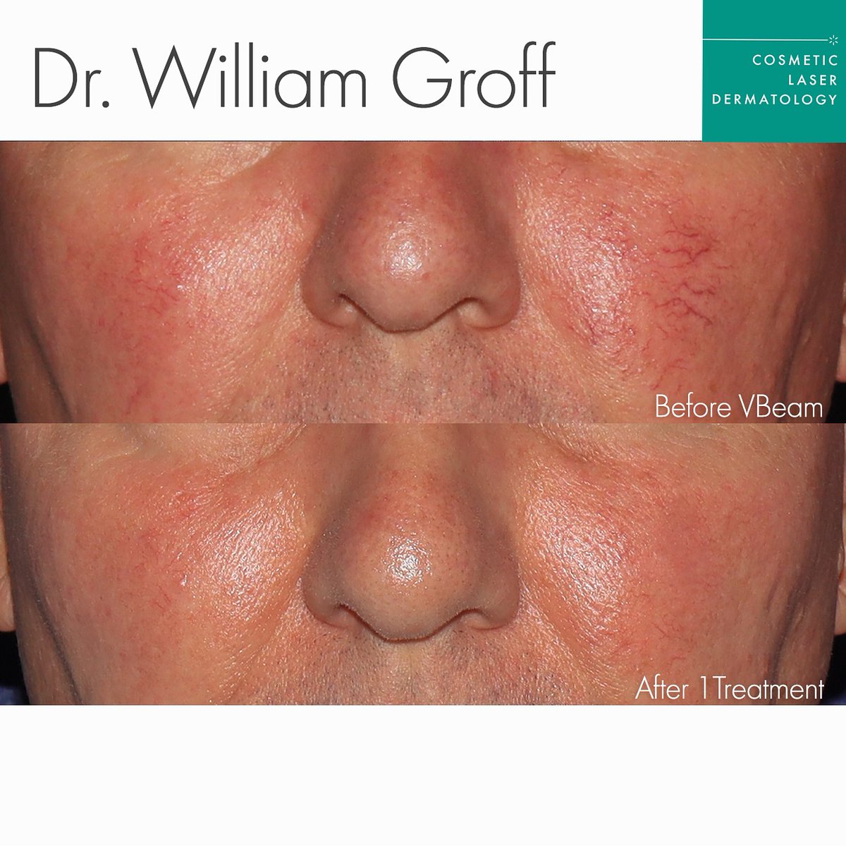 CandelaMedical1's tweet photo. A beautiful transformation by Dr. William Groff , expertly addressing his patient’s redness and broken capillaries after just a single session using the Vbeam Laser.
#Vbeam effectively targets vascular concerns with precision and care, restoring clear, even-toned skin.
REPOST https://t.co/xRgYNiSxXE