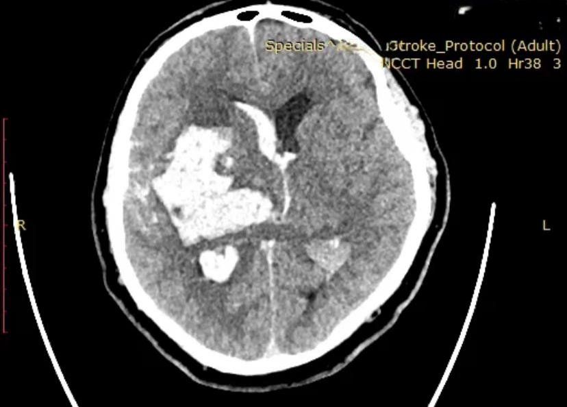 📢 NCSI Bulletin Alert! 🩺
30th November 
6-7pm
This edition focuses on the critical topic of Blood Pressure Management in Intracerebral Hemorrhage. Managing blood pressure during ICH is both challenging and pivotal, as it directly impacts patient outcomes.
🔍 Highlight:
A recent