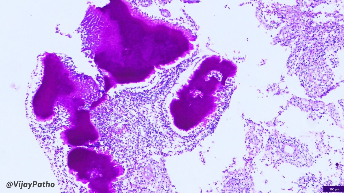 VijayPatho's tweet image. &quot;A picture is worth a thousand words!&quot;
 In publications, specially in Pathology, visuals like illustrations, microscopic images, gross images, special stains, IHC, molecular pathology, graphs, and even cartoons convey more than words ever could. We&apos;ve seen some great images in…