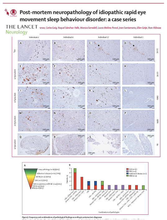 Want to take the first look at post-mortem neuropathology in idiopathic REM Sleep Behavior Disorder in both folks who develop and 'do not develop' Parkinson and other diseases? Gerard Mayà and colleagues let us peek at a series of people w/ sleep studies in the <a href="/TheLancetNeuro/">The Lancet Neurology</a>.
