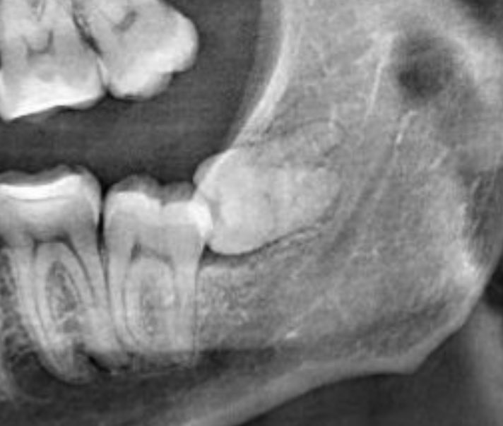 Почему их называют зубами мудрости, это же зубы тупости