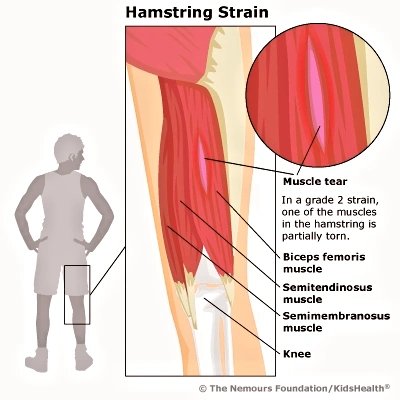 KasperJanssen's tweet image. #Hamstring #injury? 

#Ask, #listen, #speak to the #athlete!

By #sports #physician Hans Tol @amsterdamumc 

#SMWJC24 @Sportmedisch  @Sportzorg