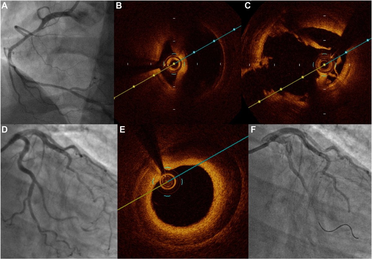 🔓 For a limited time until November 30, we are offering free promotional access to this new article in #CJC! 👇
Safety of Intracoronary Imaging in Patients With Spontaneous Coronary Artery Dissection
onlinecjc.ca/article/S0828-… 🌐
