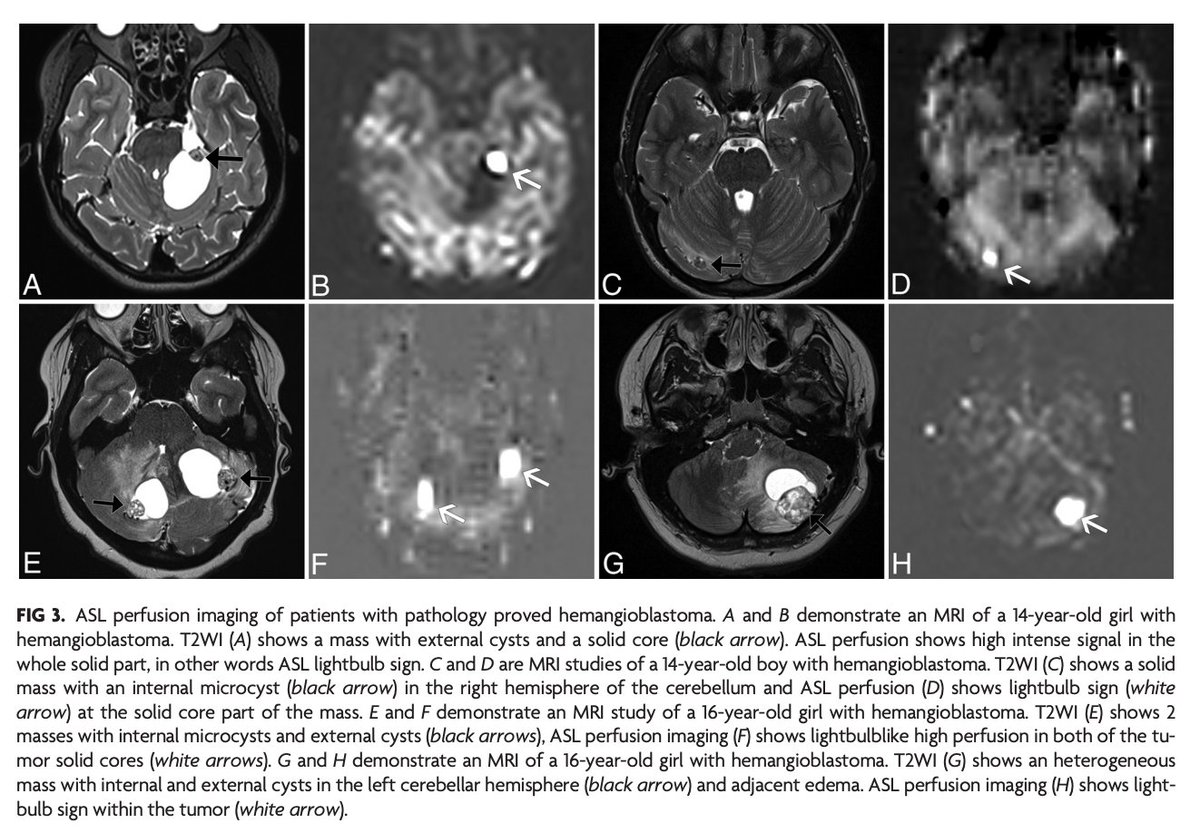 TheAJNR's tweet photo. "Arterial Spin-Labeling Perfusion Lightbulb Sign: An Imaging Biomarker of Pediatric Posterior Fossa Hemangioblastoma"

https://t.co/b4uYbY05ys

@onursimsekMD; @armanten; @draash; @timroberts_phl; @chopradiology; @The_ASPNR https://t.co/QLqpPVOJb7