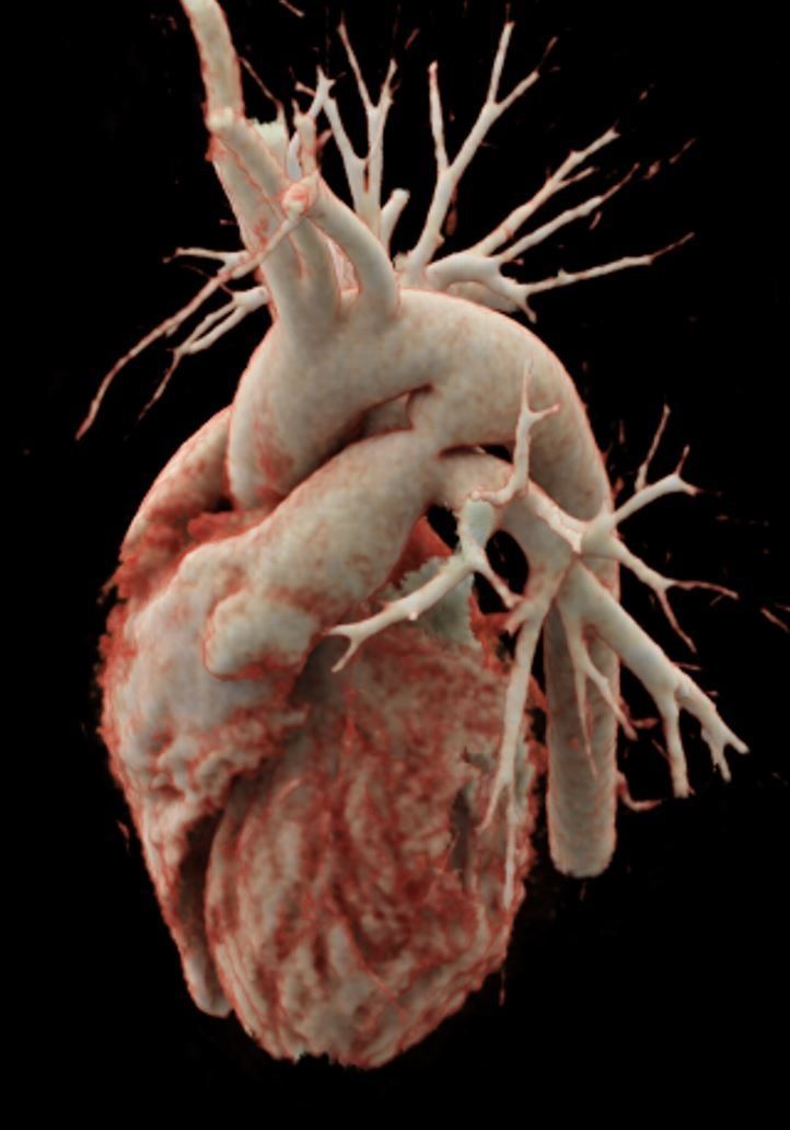 SEIC - Sociedad Española de Imagen Cardíaca (@imagencardiaca) on Twitter photo NUEVO #miniCASO Cardio TC #74 de Ana Ezponda <a href="/AnaEzponda/">Ana Ezponda</a>
🔎 buff.ly/4gqXNsf ◀️
¿Cuál es su diagnóstico a partir de esta imagen volumétrica? NUEVO #miniCASO Cardio TC #74 de Ana Ezponda <a href="/AnaEzponda/">Ana Ezponda</a>
🔎 buff.ly/4gqXNsf ◀️
¿Cuál es su diagnóstico a partir de esta imagen volumétrica?