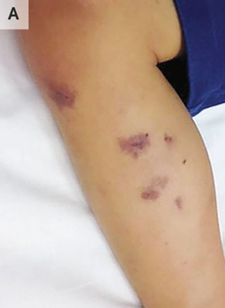 guerreroespejo's tweet photo. 3 años♂️: fiebre, vómitos y púrpura en las piernas (A) que se extendió a cara, abdomen y extremidades en las 3 horas siguientes.

En las 6 horas siguientes: se extendió más (B) y shock séptico.

Antibiótico de amplio espectro
1/3

DOI: 10.1056/NEJMicm1700231
#Infecciosas #MedEd https://t.co/9yOHODtGF4