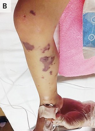 guerreroespejo's tweet photo. 3 años♂️: fiebre, vómitos y púrpura en las piernas (A) que se extendió a cara, abdomen y extremidades en las 3 horas siguientes.

En las 6 horas siguientes: se extendió más (B) y shock séptico.

Antibiótico de amplio espectro
1/3

DOI: 10.1056/NEJMicm1700231
#Infecciosas #MedEd https://t.co/9yOHODtGF4