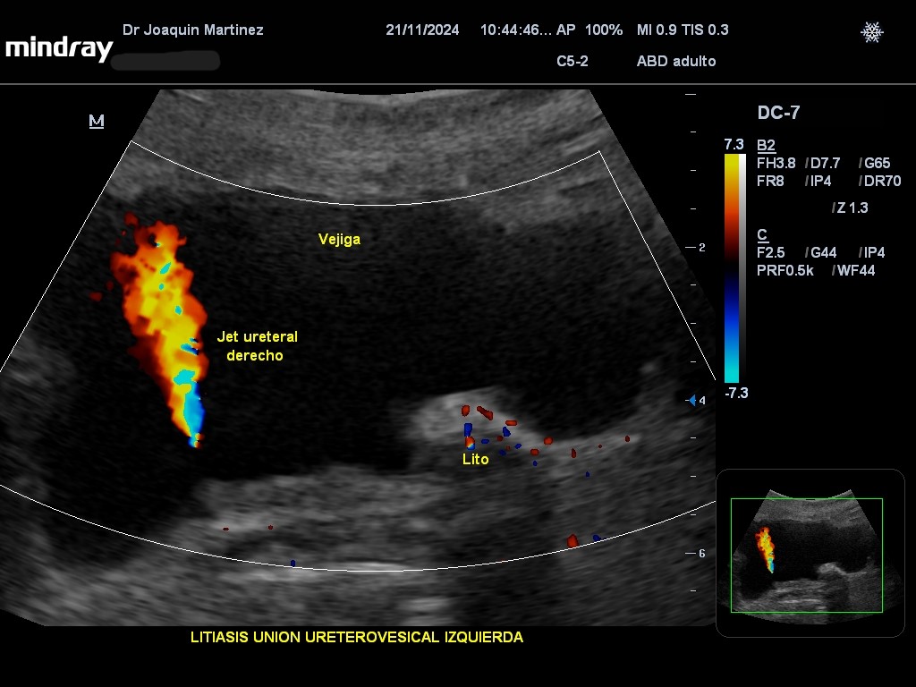 JMMR83's tweet photo. Litiasis ureterovesical izquierda y jets ureterales
@NephroP @anaseguragrau @y_interna @yaletung @SonoSamMD @curromir @zbriote @PierpaDiNick @ABCDEcografia @jpalacinp @jorgezzb @ignaciomsb @mberchid @AlvarezHigueras @EcosemfyC @USPed_Latam @drPowerDoppler @OswaldoRamosN https://t.co/Wkt1MoqVPe