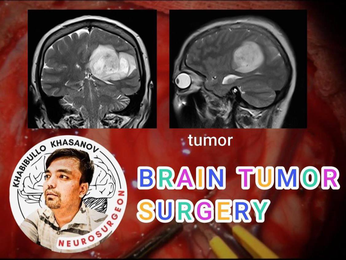 HabibullohMD's tweet image. We perform all types of braintumor, skullbase surgery, endoscopic transsphenoidal approach to #PitNET and endoscopic spine surgery. For more information visit my youtube channel in my bio.