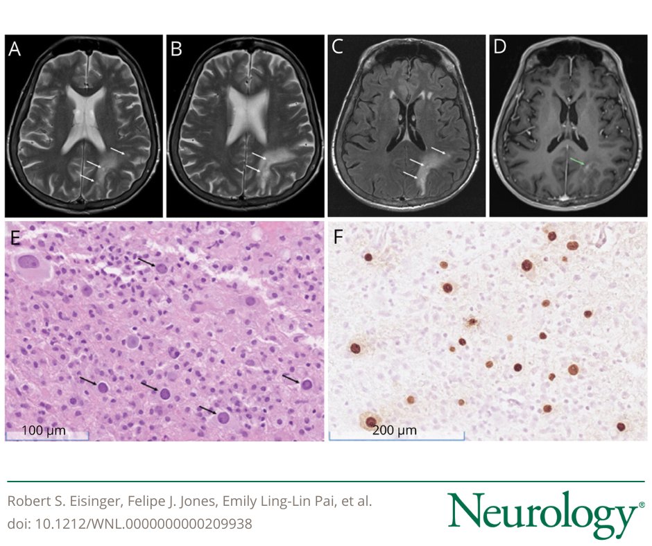Ideomotor Apraxia and “Milky Way” Sign in Progressive Multifocal Leukoencephalopathy: bit.ly/4i1CbEp

#NeuroX #NeuroTwitter