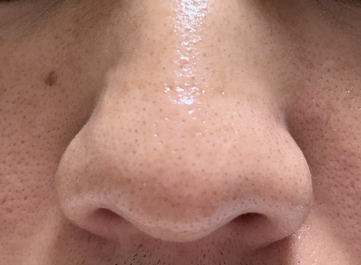nikibman's tweet photo. 家で出来るハイドラフェイシャルAmazonで買ったので僕の鼻で実験中です👃

毎週1回でハイドラ後は、ピーリング→ビタミンCセラム塗ってます。
(吸引力強過ぎるので注意)

左がやる前。
右が2回目終わったところです。

効果は今のところ無さそう笑
次はアゼライン酸のクリームに変えてやってみます！ https://t.co/QnXB1zPblv