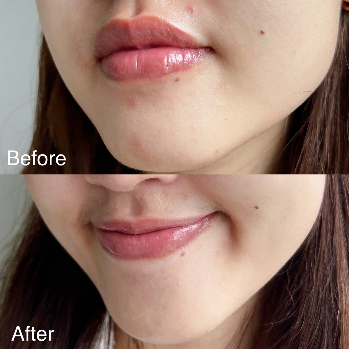 Juv Skin Barrier Cica Ampoule ลดสิวดีมากกกกกก สารสกัดเด่นคือ Centella Asiatica กับ ESP SEAGLOW ใช้แล้วสิวลดลง ผดหาย ผิวไม่อักเสบ ไม่ค่อยระคายเคืองง่ายเลย ใช้ต่อเนื่อง ผิวดูใสอมชมพูขึ้นด้วย นี่ขึ้นขวด 2 แล้ว มันจึ้งงงง 🍀💕 https://t.co/7WYh7Yl40h