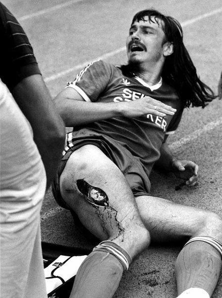 drayy09's tweet photo. The most disturbing injuries in football history (Viewers Discretion)😨😱

A Thread

1. Ewald Lienen (1981) https://t.co/9ZRDV1LK6z