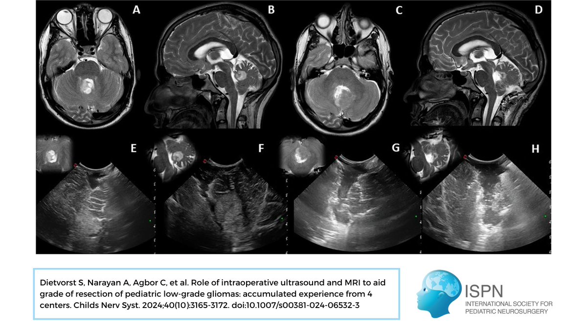 📰: Dietvorst et al. conducted a retrospective analysis across four European tumor registries to evaluate the role of intraoperative ultrasound and MRI on achieving complete resection in pediatric low grade gliomas. #ChildsNervSyst #pLGG

🔗: link.springer.com/article/10.100…