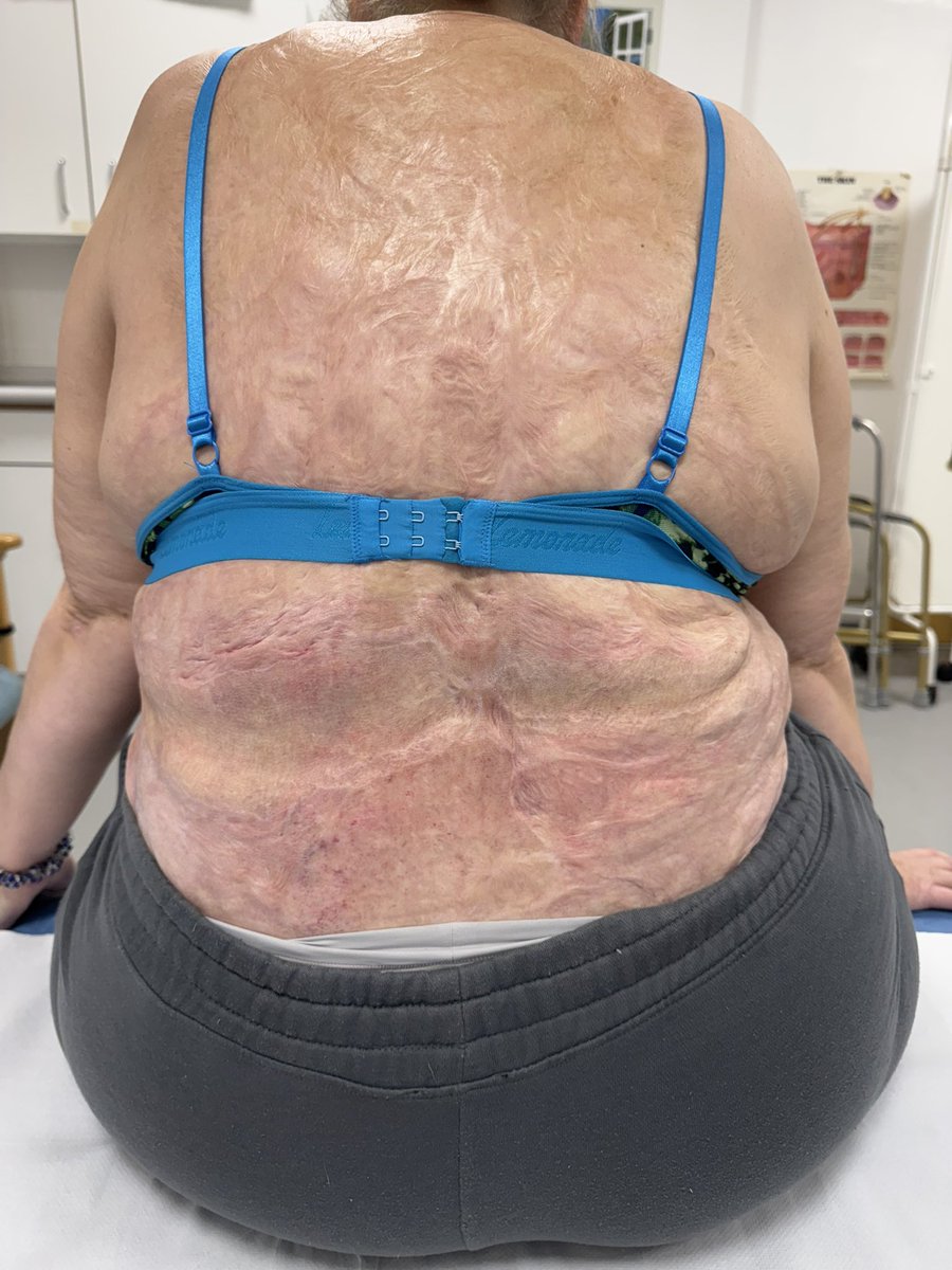 My 3rd ‘epidermologie’ (LPG) treatment to my back of burn scars. My lovely therapist Vicky is working on my lower back &amp; this is my 3 of 6 week treatment. It’s uncomfortable as I have dead nerves in places and using high setting #BurnSurvivor #Scars <a href="/DansFund4Burns/">Dan's Fund For Burns</a> <a href="/KPFoundation/">The Katie Piper Foundation</a>