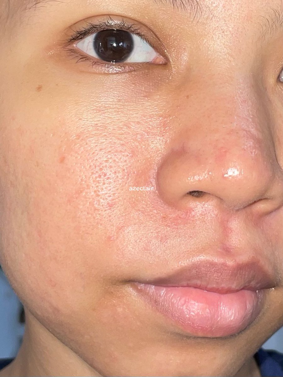 azeclair's tweet photo. BACK TO KOREAN SKINCARE✨🫵
kalau kulit udah iritasi merah2 gak jelas.

beginilah ya gess dilemma kulit acne prone🫠 https://t.co/BazjZFcQYz