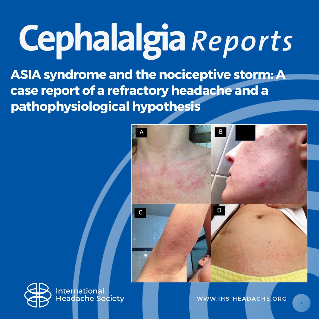 This case reports a patient's secondary headache due to ASIA syndrome, and provides a brief review of the problem and its pathogenesis, making it the initial effort to analyze the clinical patterns of this immune-mediated headache.
journals.sagepub.com/doi/10.1177/25…
#headache #neurology