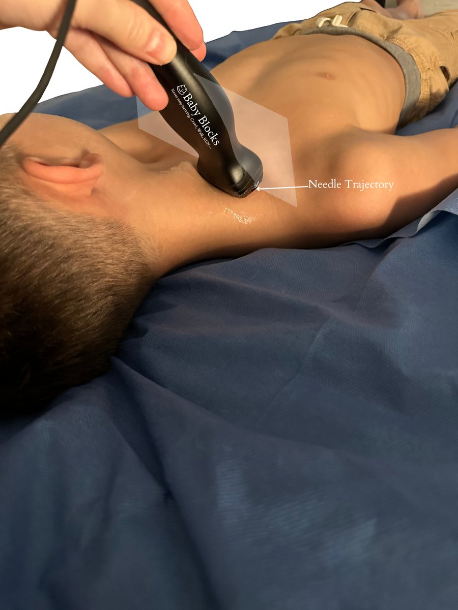 The Supraclavicular block is a stalwart in N. America for dense brachial plexus blockade. Fun fact: While preferences vary geographically the world over, it accounted for over 50% of upper extremity blocks in PRAN’s 2018 study (Walker et al).

baby-blocks.com/block-detail/s…