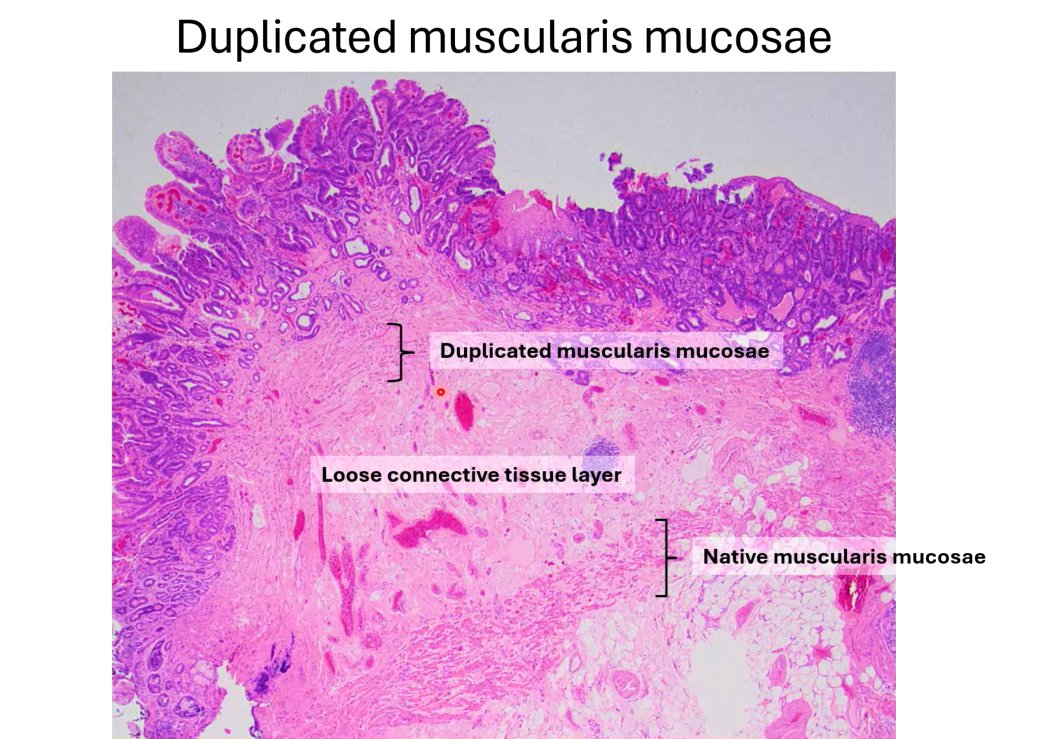 Janiranavarro's tweet image. Esophagus-duplicated muscularis mucosae

Dr. Bell #CAP24 #pathology #pathologists #PathTwitter #PathX #pathresidents #pathfellow #GIpath